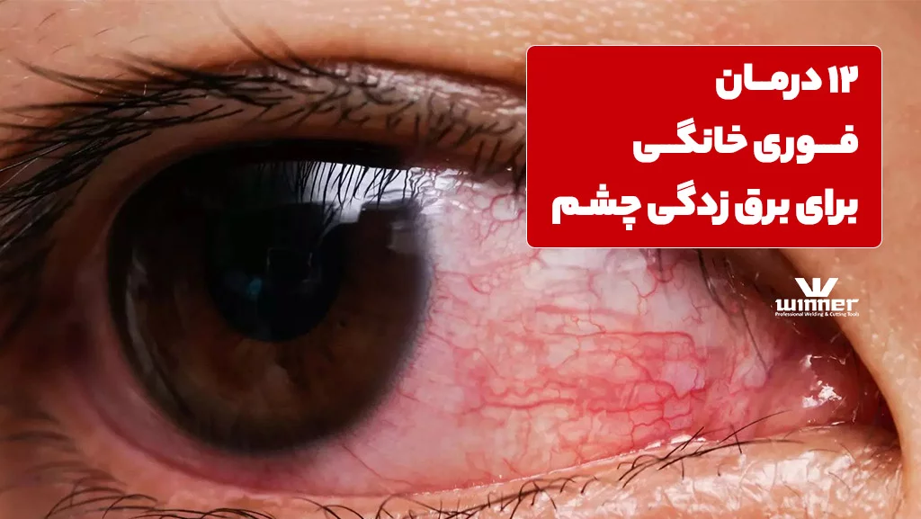 درمان فوری خانگی برای برق زدگی چشم